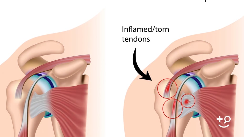 complete tear of left rotator cuff unspecified whether traumatic icd 10