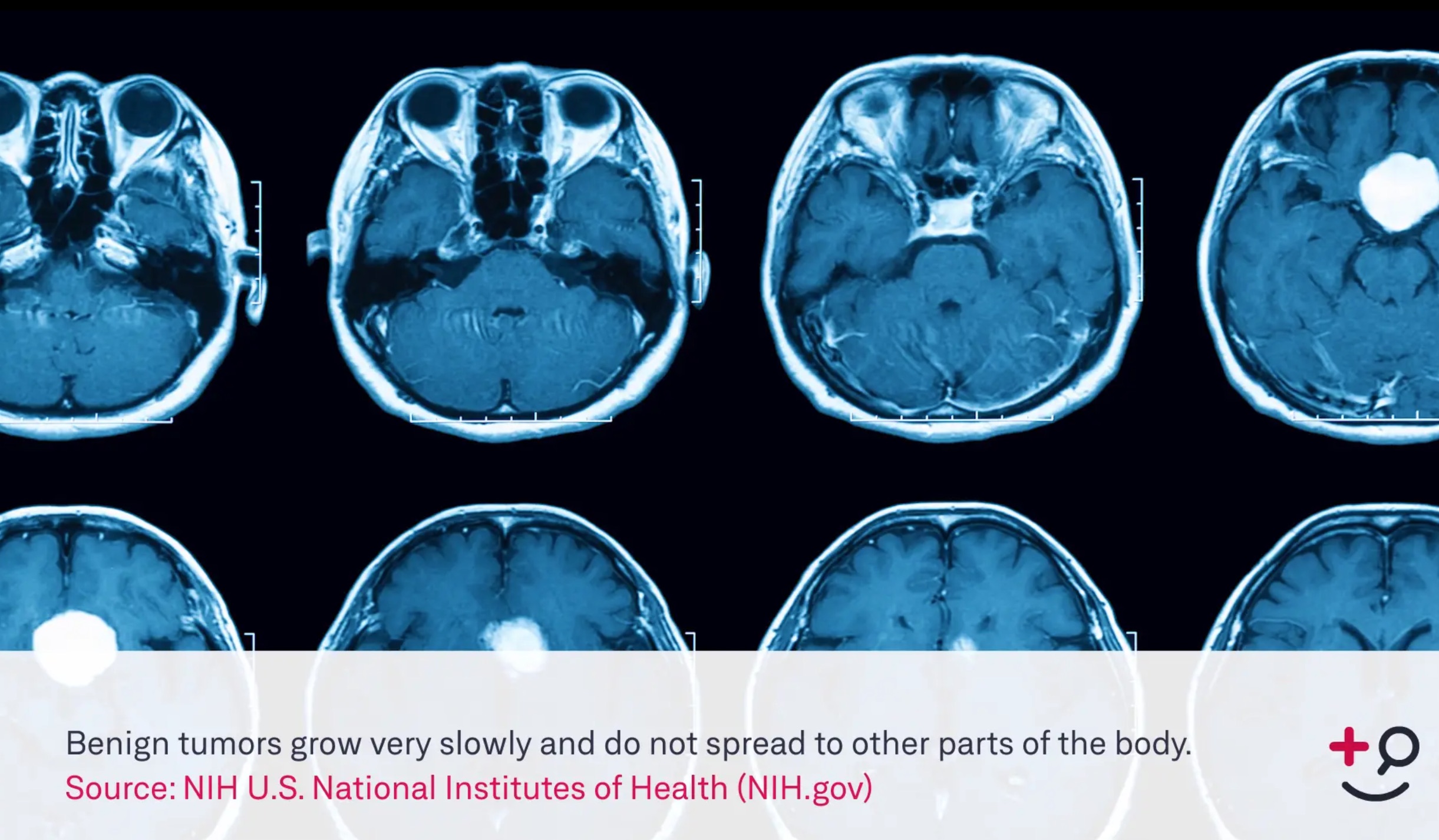 Pituitary Tumor Pituitary Masses Definition Doctorpedia 0936