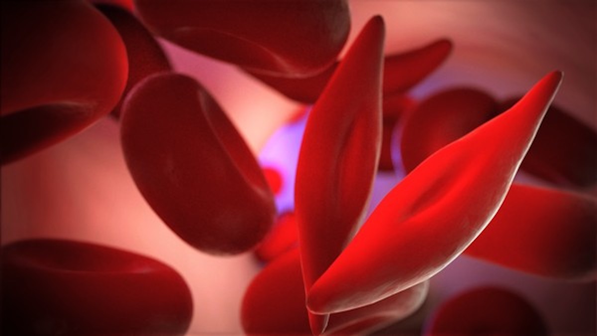 Gene Therapy for Sickle Cell Disease - Latest Research