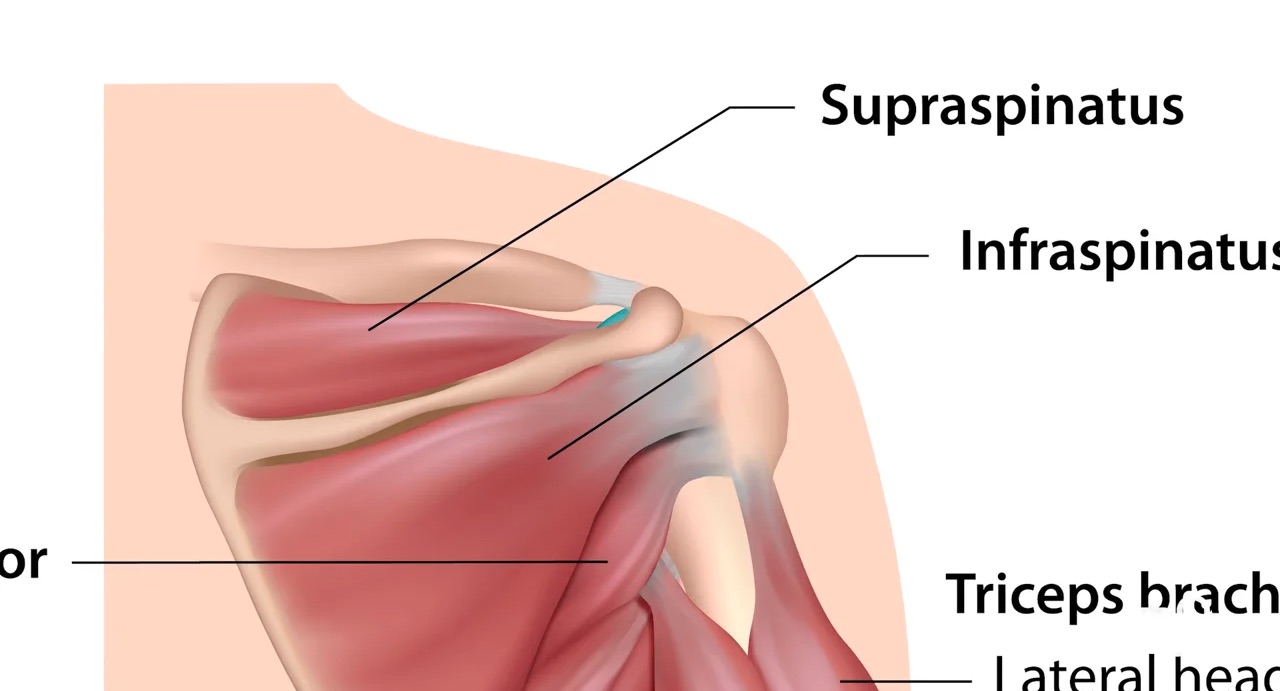 Rotator Cuff Tear - Surgery Recovery - Doctorpedia