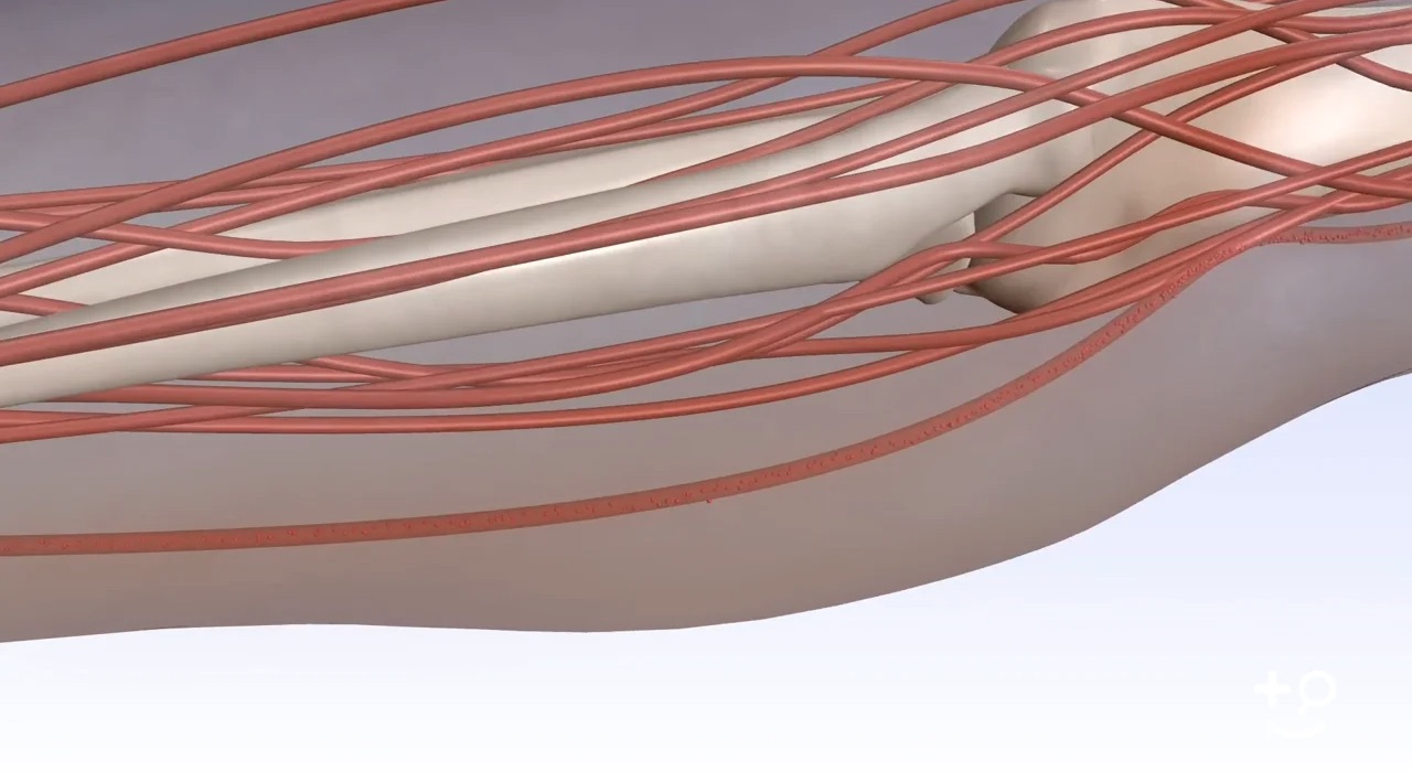 Varicose Veins - Thrombosis - Doctorpedia Doctor-Reviewed Video